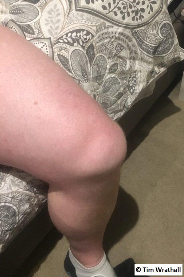 My damaged knee, one our after it happened.
